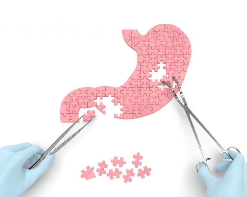 http://oncologialondrina.com.br/Imagem de Como é a cirurgia de câncer de estômago?